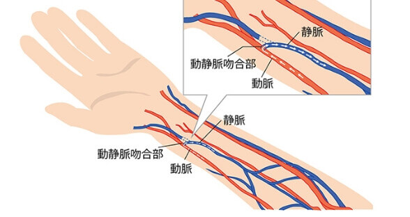 シャント手術／シャントPTA